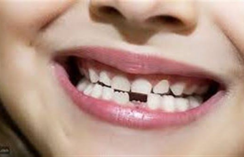 تفسير حلم سقوط الاسنان في المنام