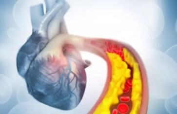 خطورة انسداد الشرايين