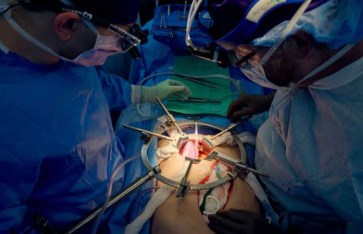 استئصال كلية خنزير 