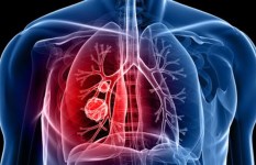 سرطان الرئة 