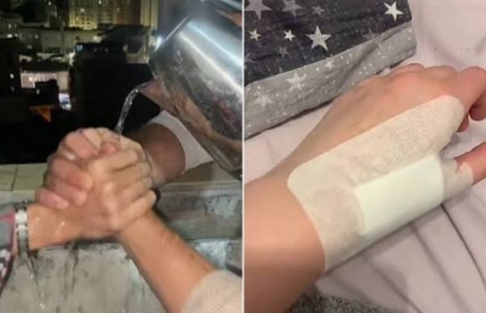 مستشفى "أهل مصر" تحذر من خطورة "تحدي المياه الساخنة" على السوشيال ميديا  