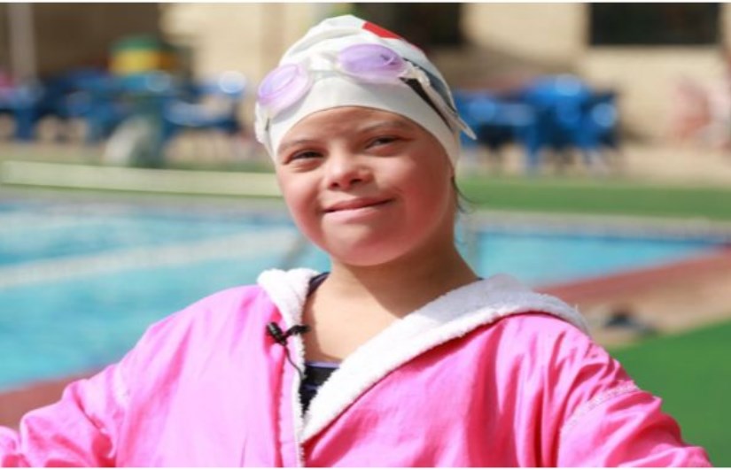 متلازمه داون 